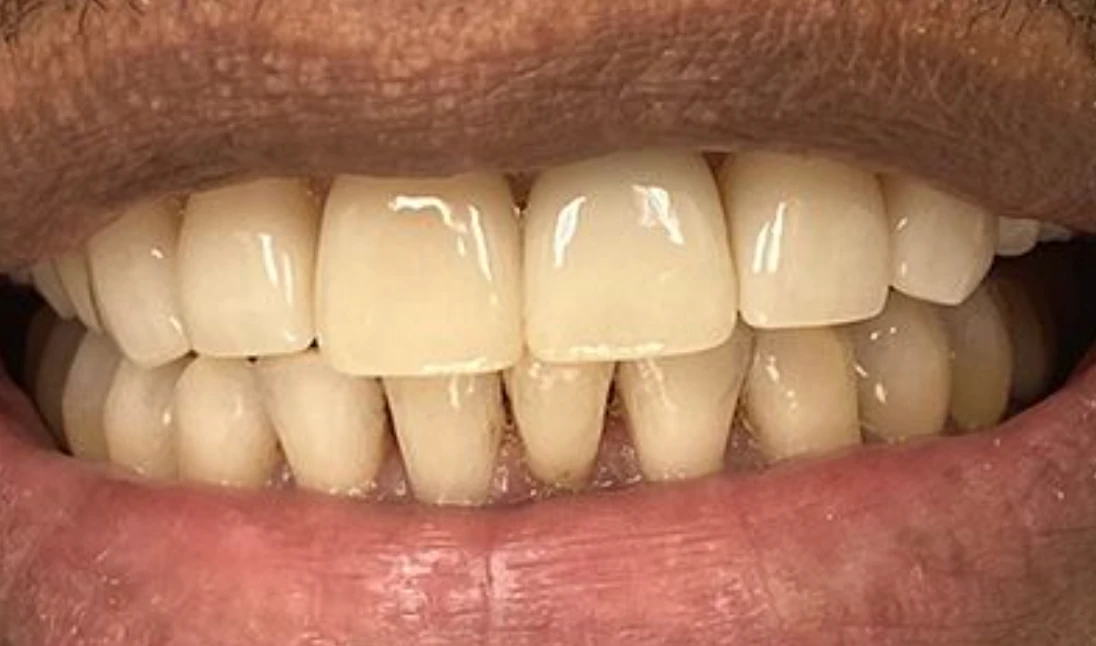 Porcelain Crowns & Restorative Care — after